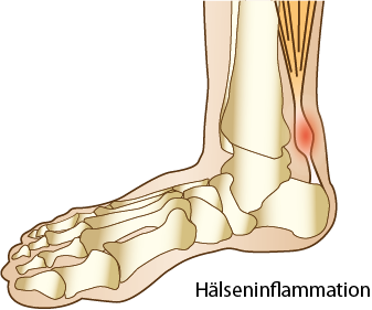 Hälseneinflammation eller Achillestenidopati camp pro