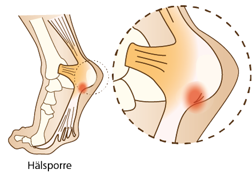 Hälsporre, Plantar fasciit och Plantar fascialgi camp pro