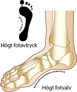 Högt fotvalv, Pes cavus symptom och behandling camp pro 